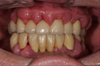 Läkemedelsinducerad gingival hyperplasi